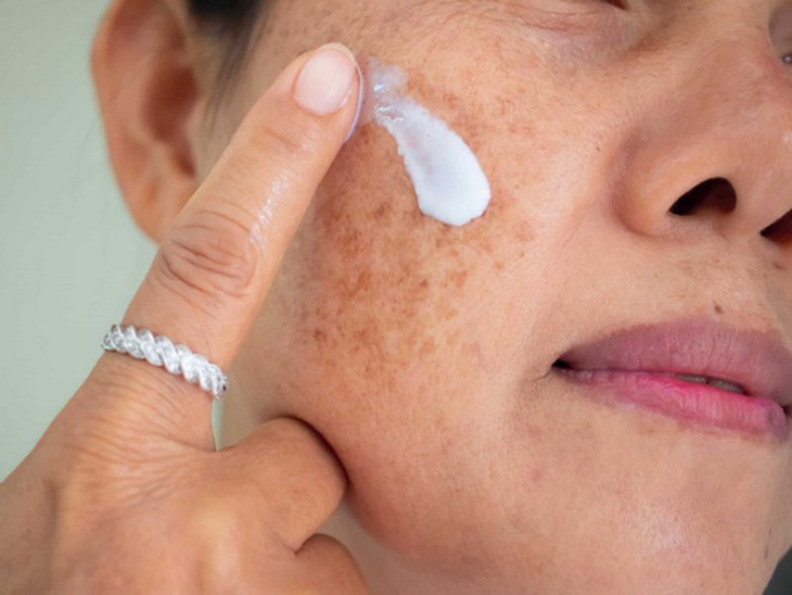 Bôi thuốc trị nám da cần tuân thủ chỉ dẫn của bác sĩ da liễu.